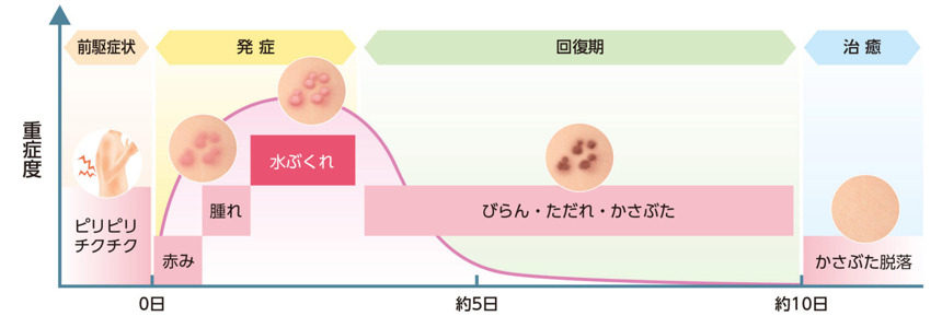 単純疱疹：ヘルペス