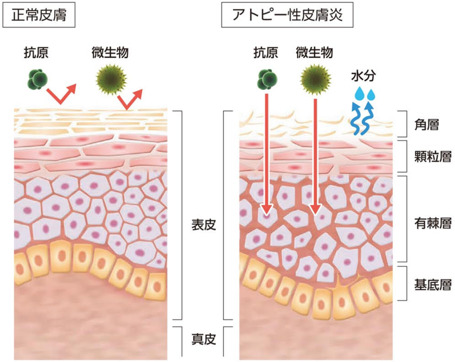 小児アトピー性皮膚炎