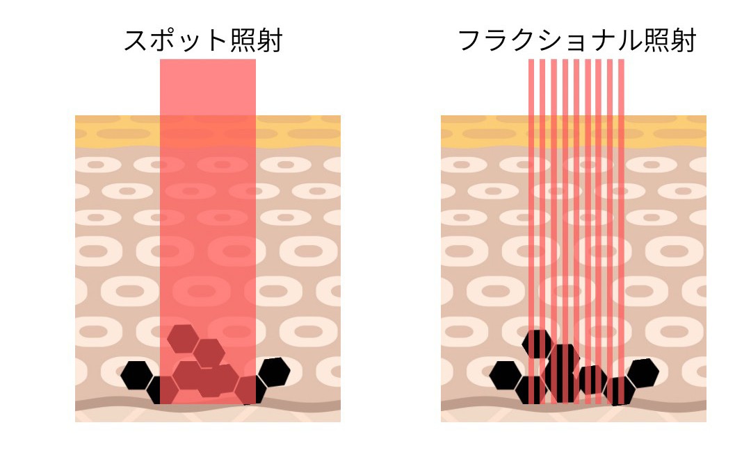 ルビーフラクショナル