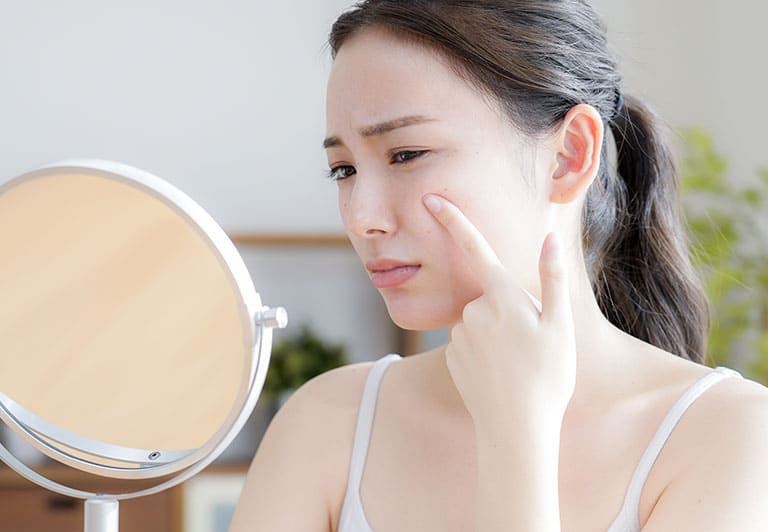 にきび・にきび痕