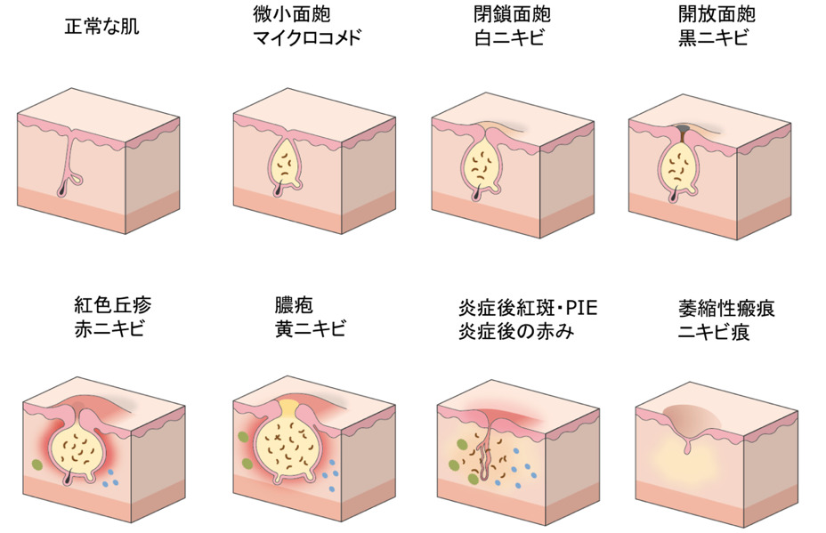 にきび痕の種類と治療方法