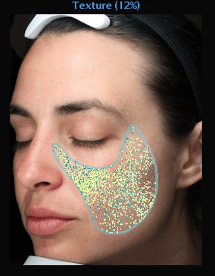 肌の色の均質性（キメ）