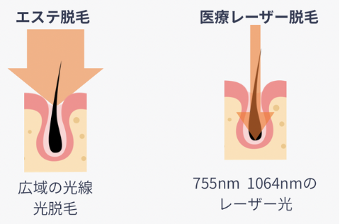 エステ脱毛との違い