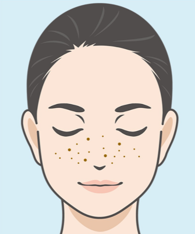 雀卵斑(じゃくらんはん)