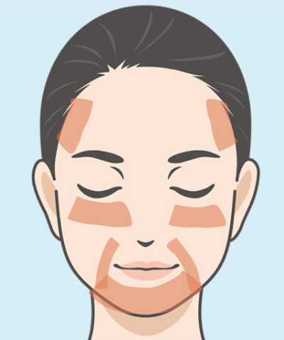 肝斑(かんぱん)