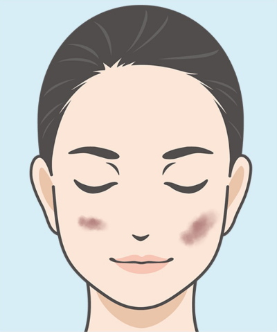 炎症後の色素沈着(PIH)