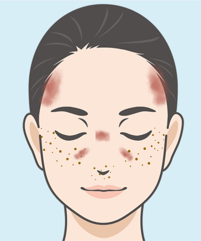 後天性真皮メラノーシス(ADM)